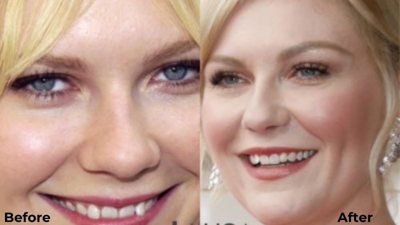 Kirsten Dunst after dental work